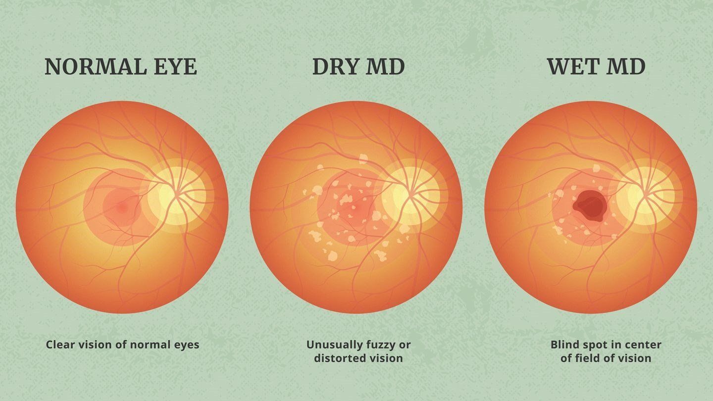 Why treatments can fail patients with 'wet' macular degeneration